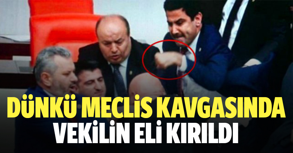 AK Partili vekilin eli üç yerden kırıldı